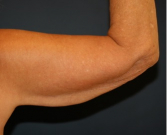 Feel Beautiful - Arm Reduction 215 - Before Photo